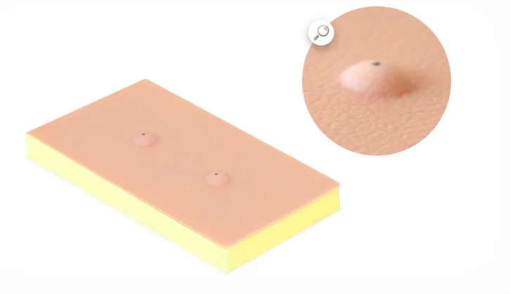 Sebaceous Cyst Pad ( 00071)